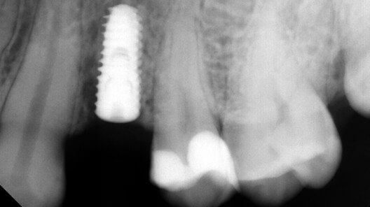 teeth after treatment