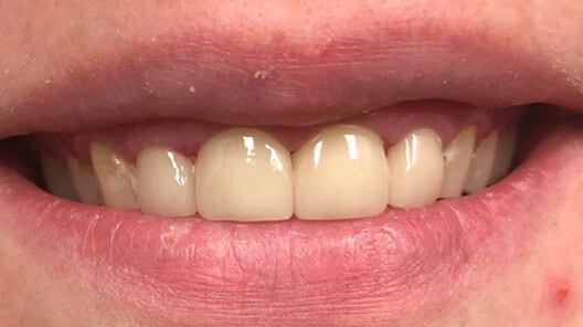 teeth after treatment