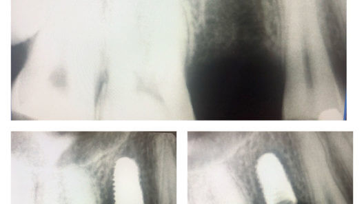 xray of tooth before implant