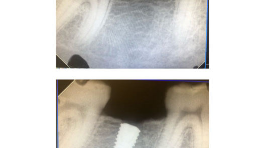 xray of tooth after implant