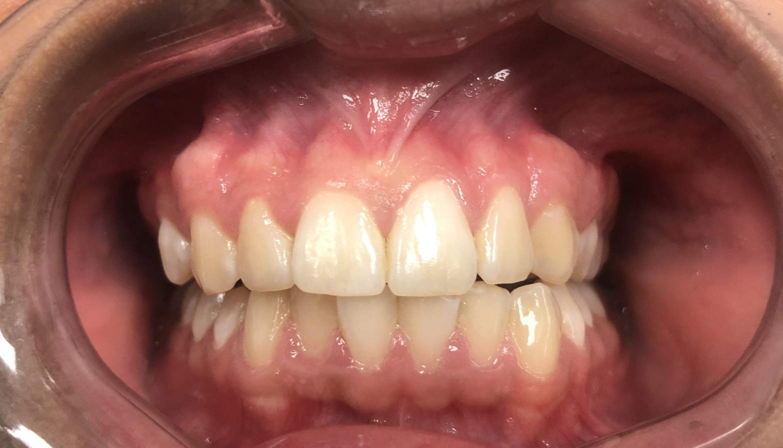 teeth before invisalign treatment