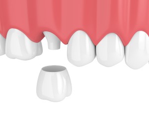 dental crowns Euless
