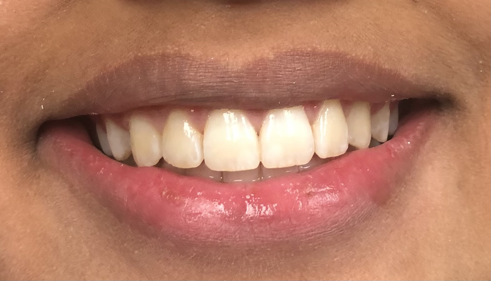 teeth after Invisalign treatment