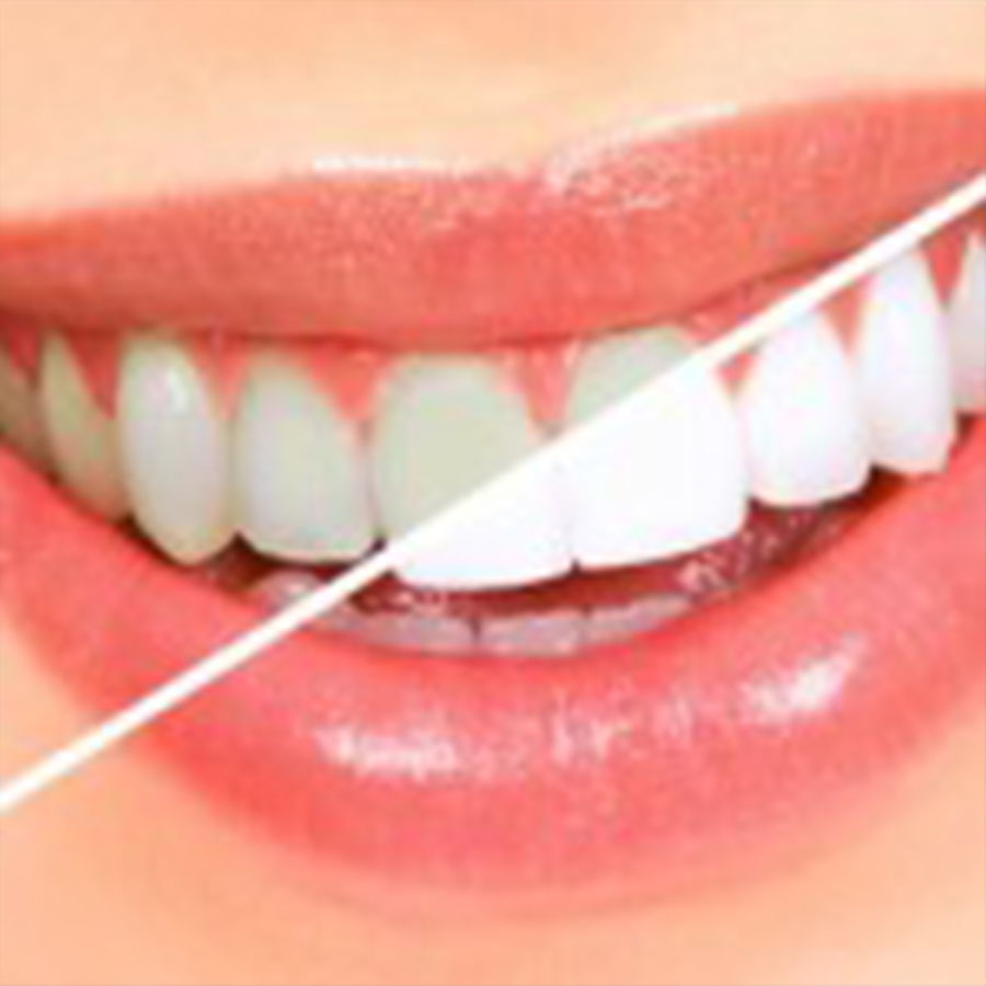 teeth whitening carrollton