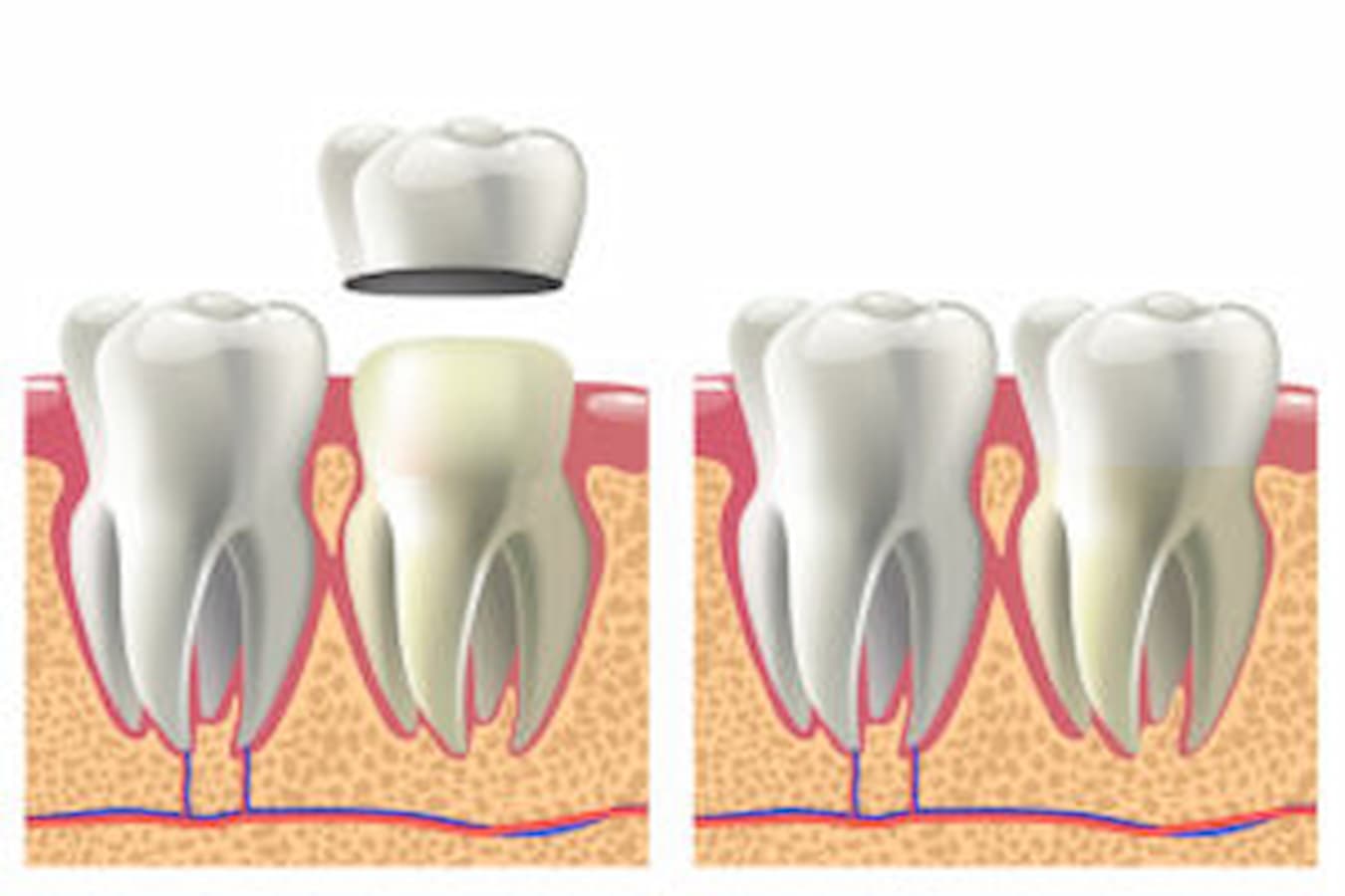 dental crowns Carrollton