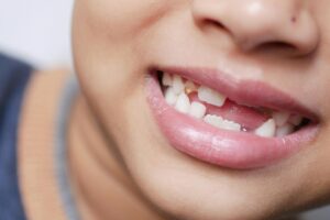 Photo by Towfiqu barbhuiya: https://www.pexels.com/photo/close-up-shot-of-a-kid-with-missing-tooth-11242723/